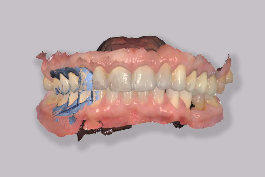 digitalni 3d sken Ada Dent Stomatološka ordinacija